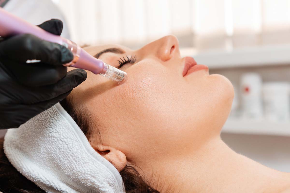 Microneedling